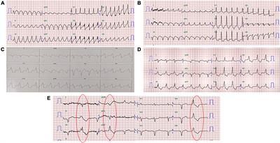 Case report: Stereotactic body radiation therapy with 12 Gy for silencing refractory ventricular tachycardia